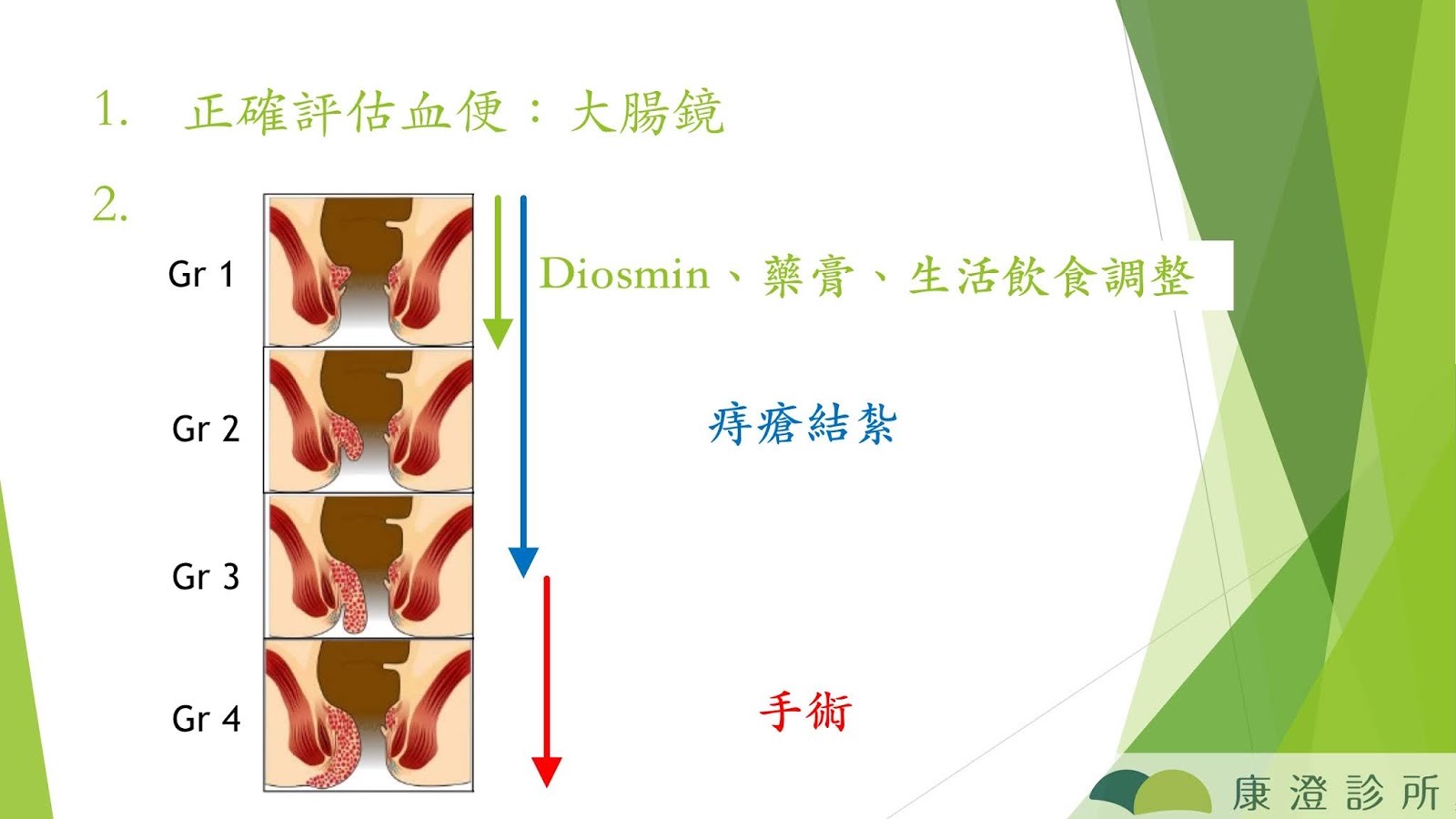 痔瘡治療流程圖：先以大腸鏡評估血便，第一至四度依序為藥物、結紮到手術