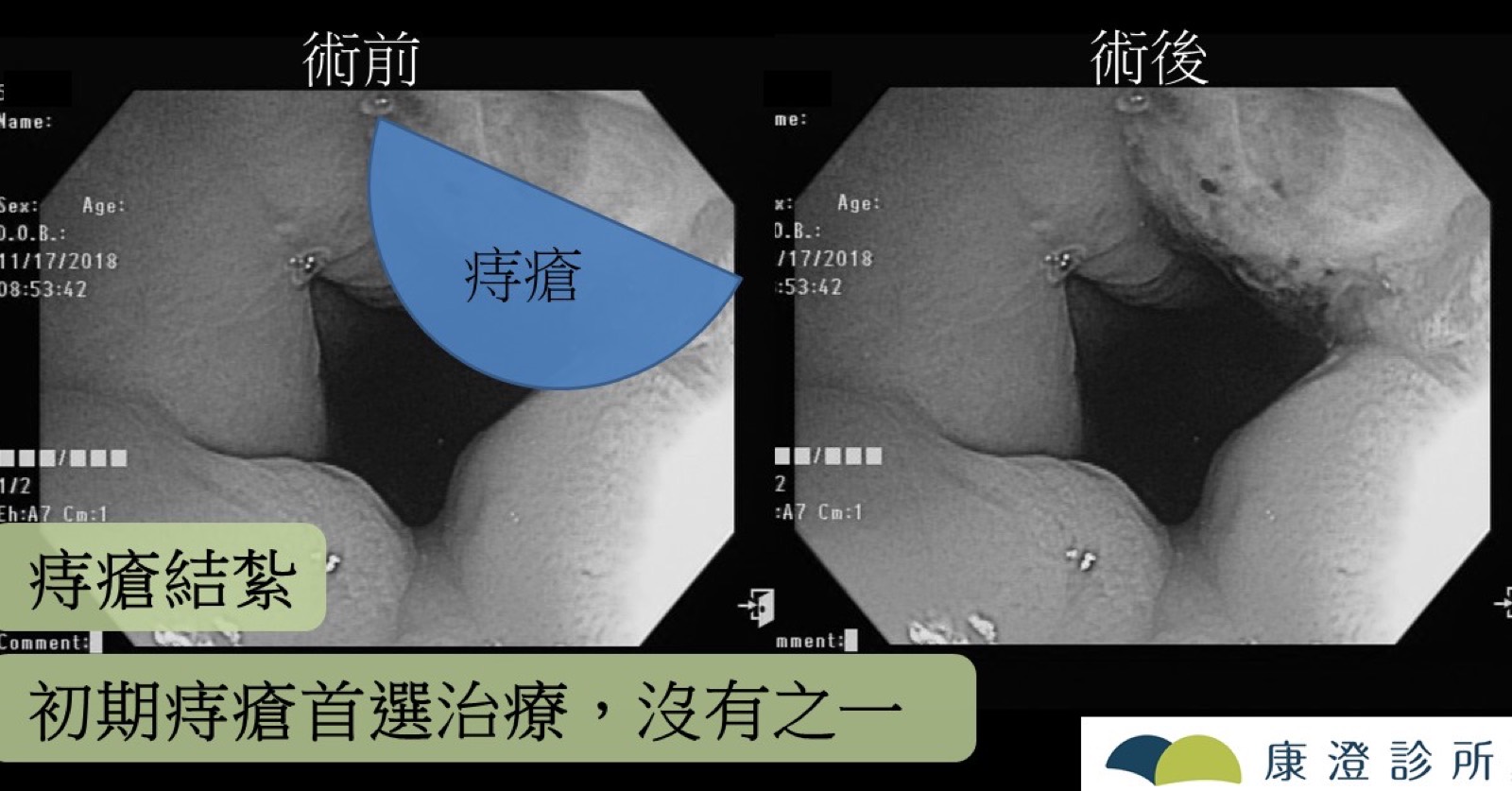 痔瘡結紮術前與術後的肛門鏡對照影像,藍色標示痔瘡位置