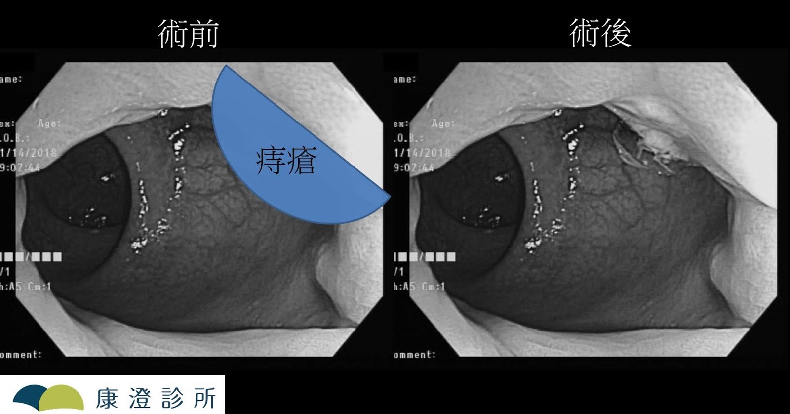 另一組痔瘡結紮術前術後的肛門鏡對照影像，藍色標示痔瘡位置